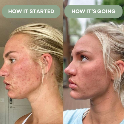 Kill Acne & Clear Your Skin