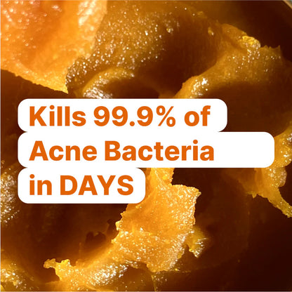 Kill Acne & Clear Your Skin